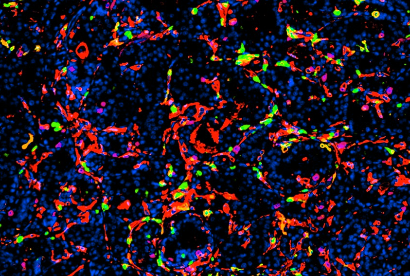 immunofluorescent image of immune cells in a prostate tumor
