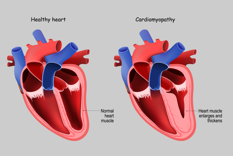 illustration of normal heart and one with hypertrophic cardiomyopathy