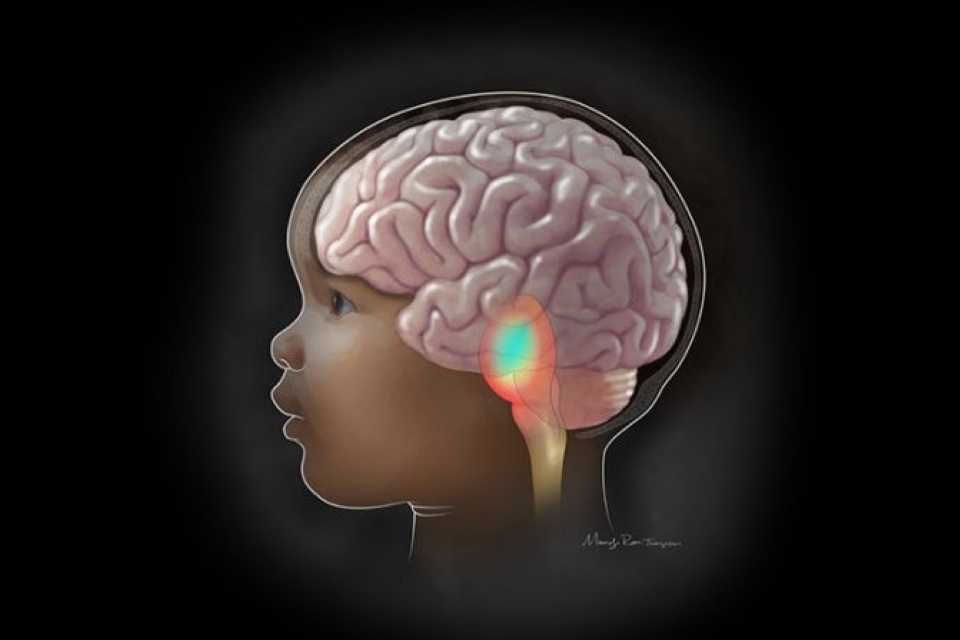 DIPG