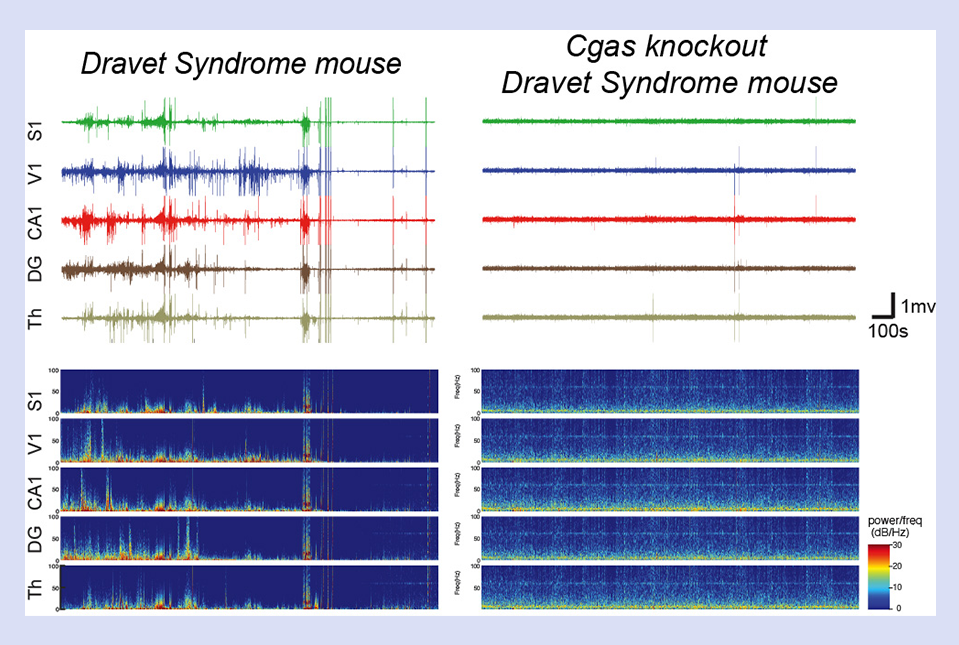 Dravet Syndrome 