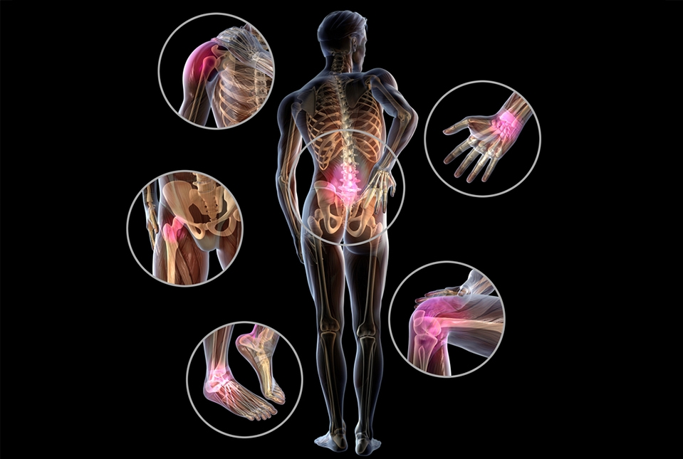 illustration of the different joints affected in spondyloarthritis