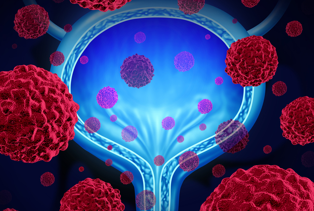 illustration of cancer cells surrounding and within bladder
