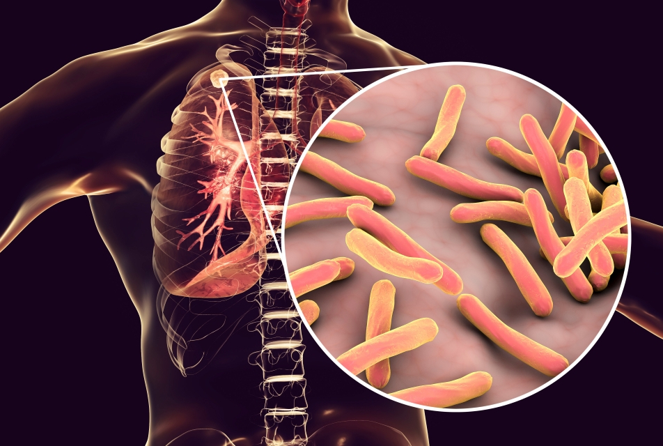 tuberculosis