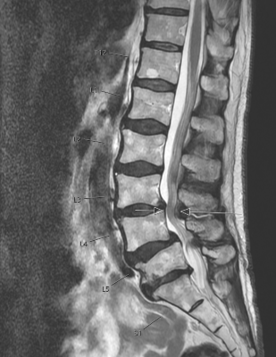 spinal stenosis