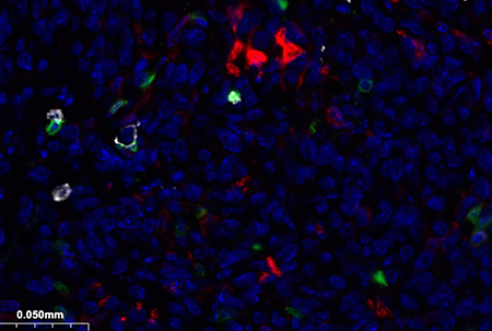 immunofluorescent image of immune cells labeled with white, red and green