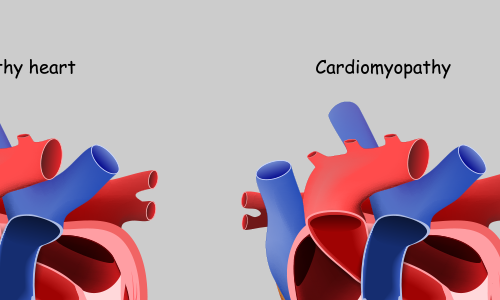 illustration of normal heart and one with hypertrophic cardiomyopathy