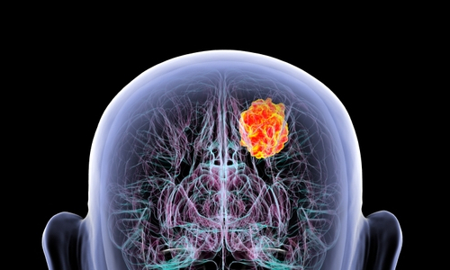 illustration of a brain tumor in a man