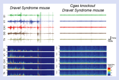 Dravet Syndrome 