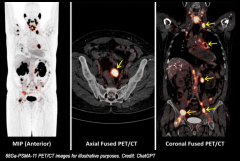 advanced prostate cancer scan