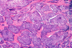 Microscopic image of ovarian cancer cells, illustrated in purple